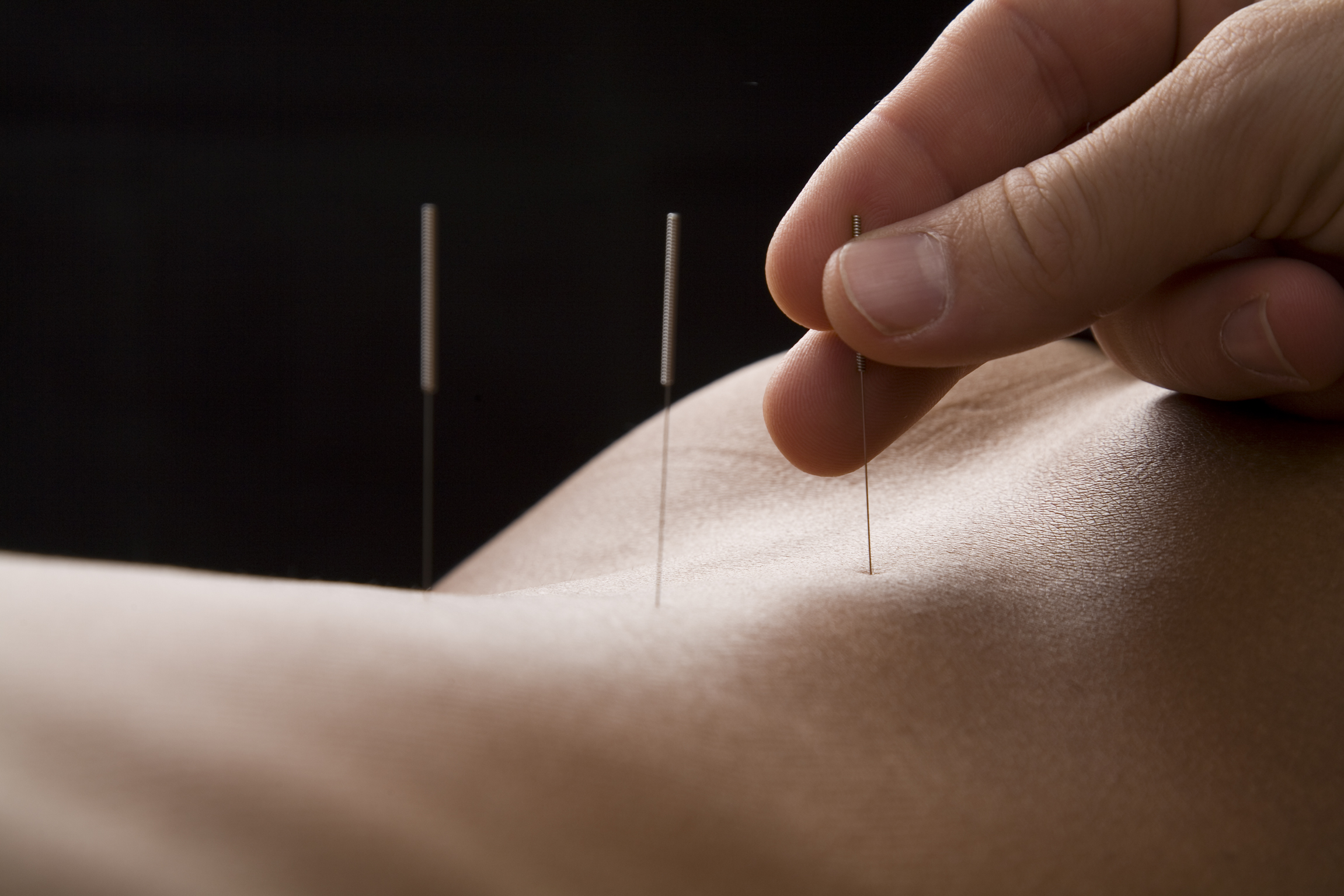 Akupunktur Nadeln am Rücken