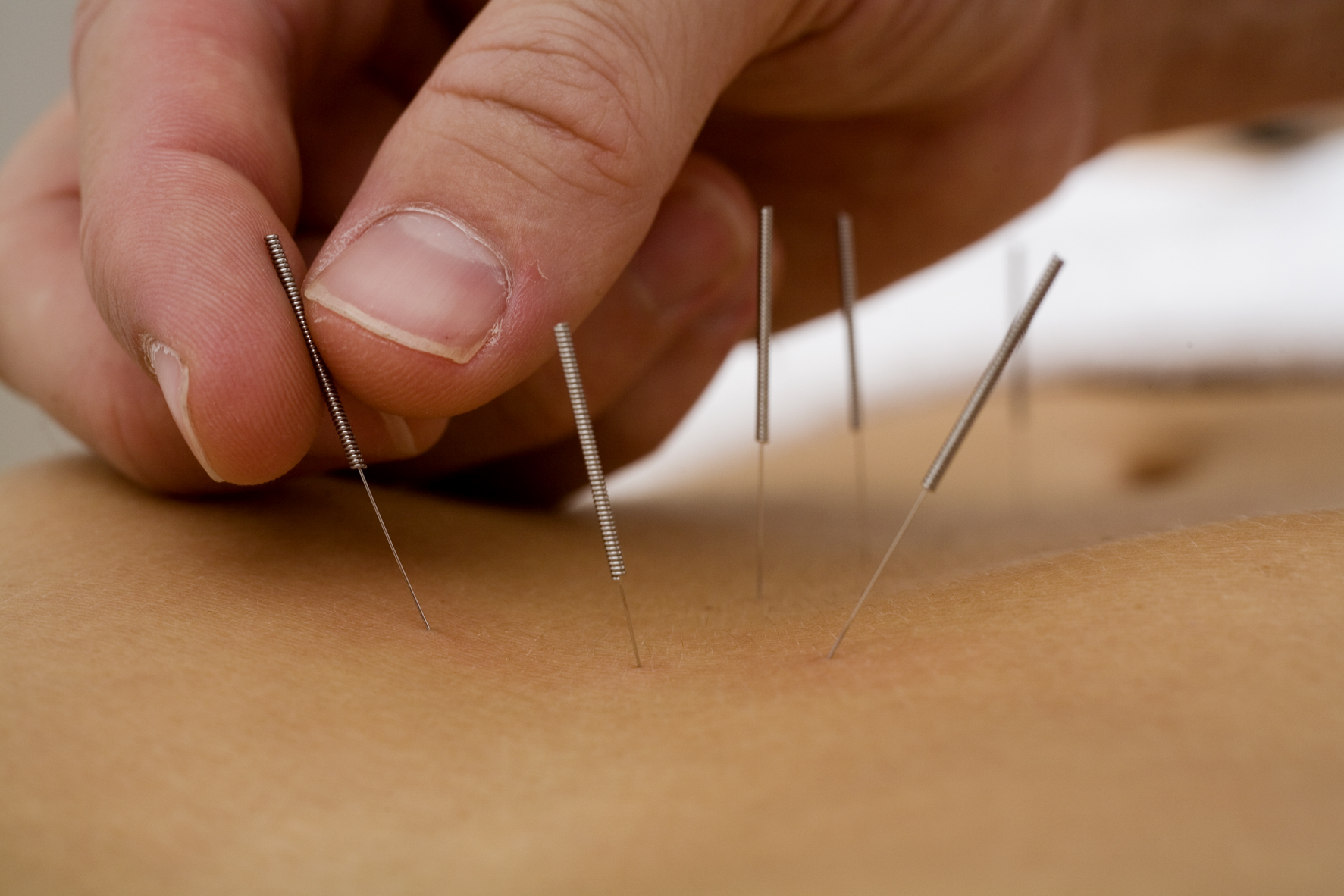 Akupunktur Nadeln Therapeut setzt Akupunktur Nadeln beim Patient