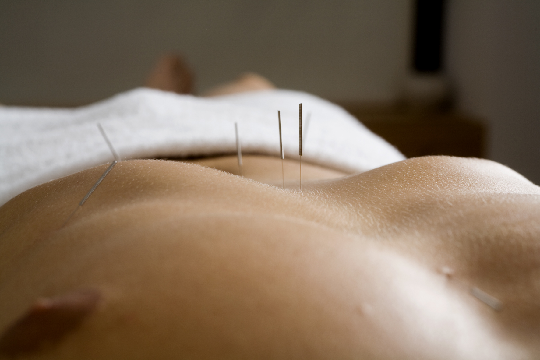 Patient erhält Behandlung mit Akupunktur Nadeln